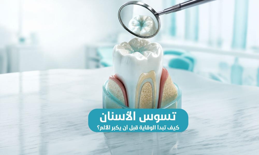 تسوس الأسنان