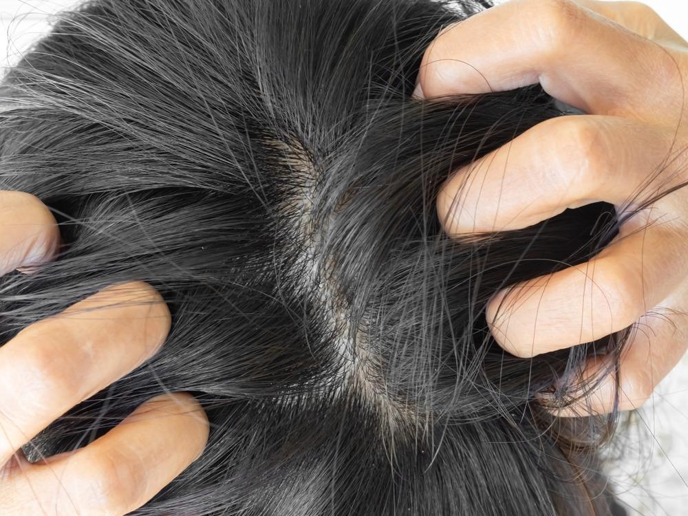 أسباب حكة فروة الرأس وكيفية علاجها طبيعيًا بالأعشاب