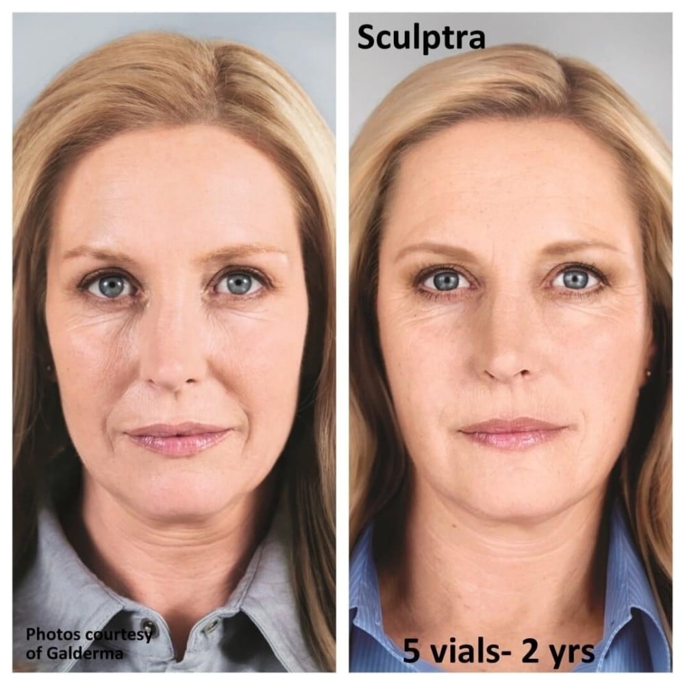حقن السكلبترا ( Sculptra ) لتجاعيد الوجه