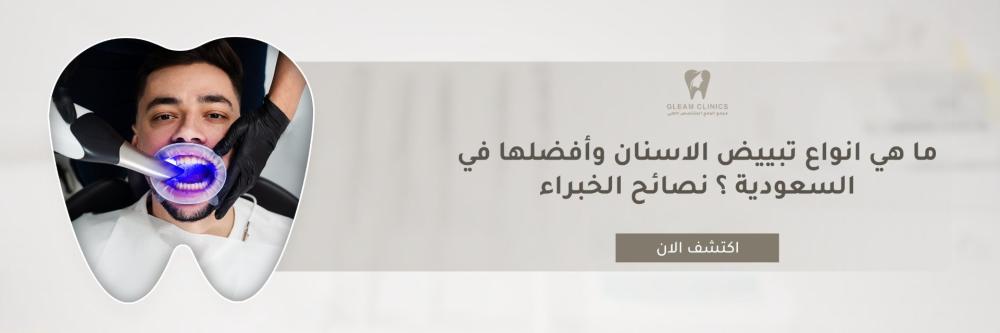 ما هي انواع تبييض الاسنان وأفضلها في السعودية ؟ نصائح الخبراء