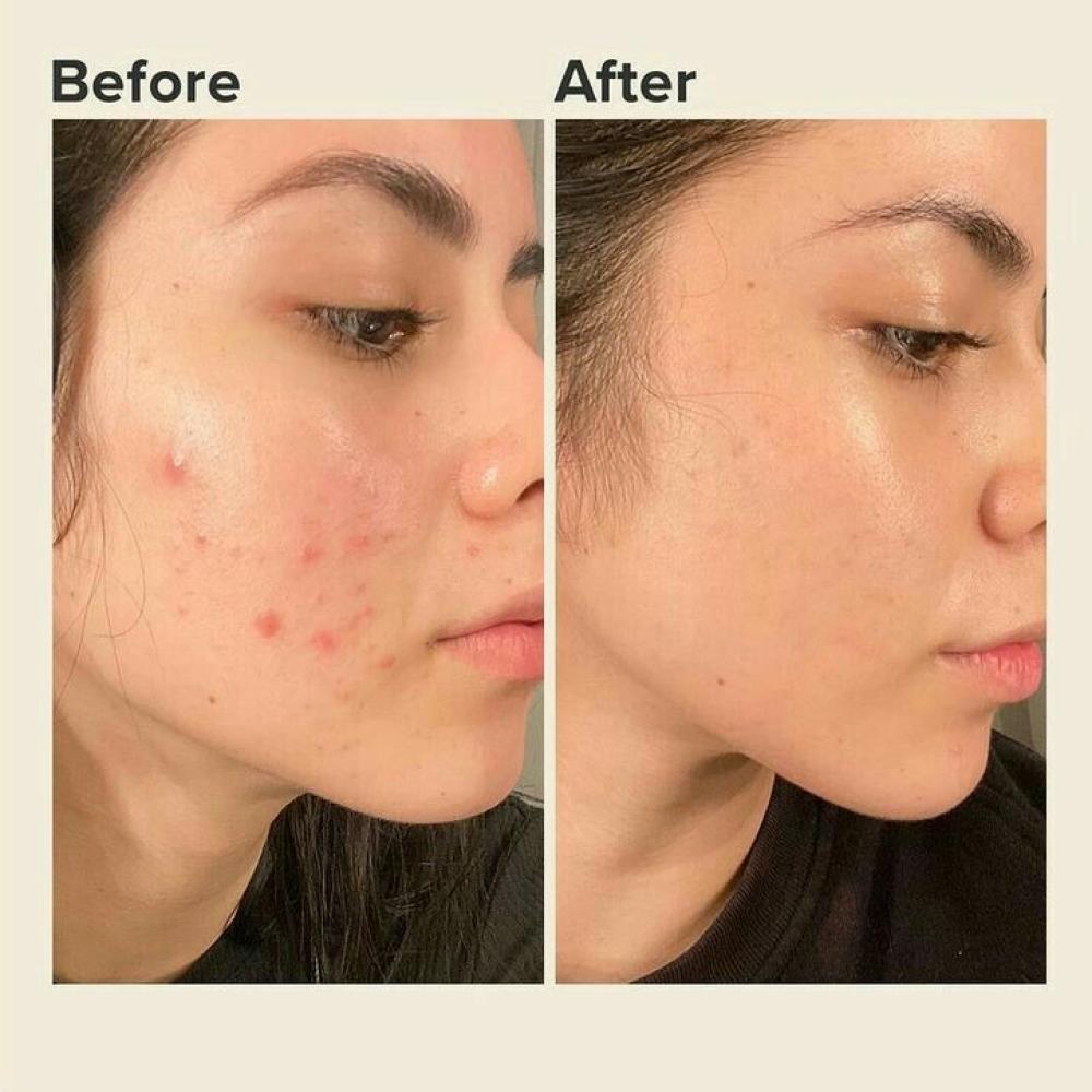 Fixing Skin Issues and Acne