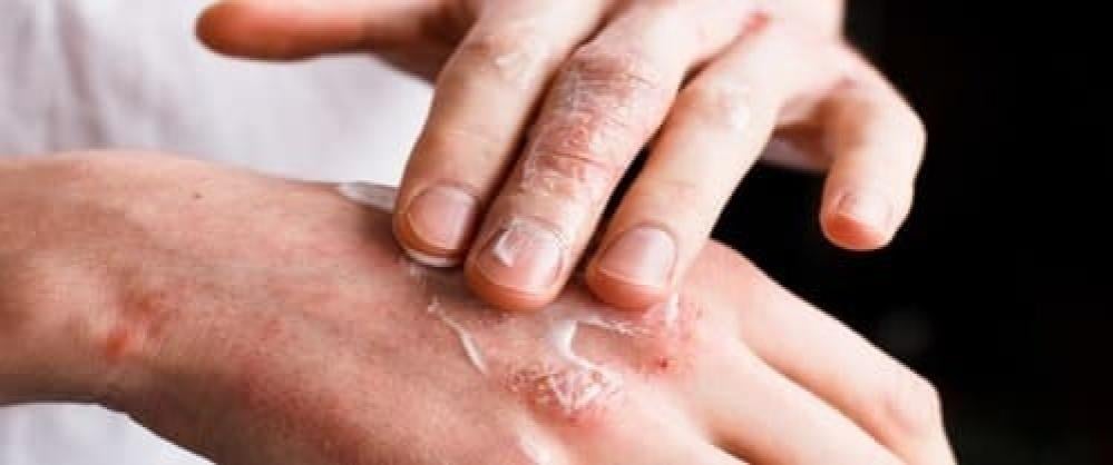 الكشف عن أسرار حساسية الجلد: الوقاية والعلاج والعناية اليومية