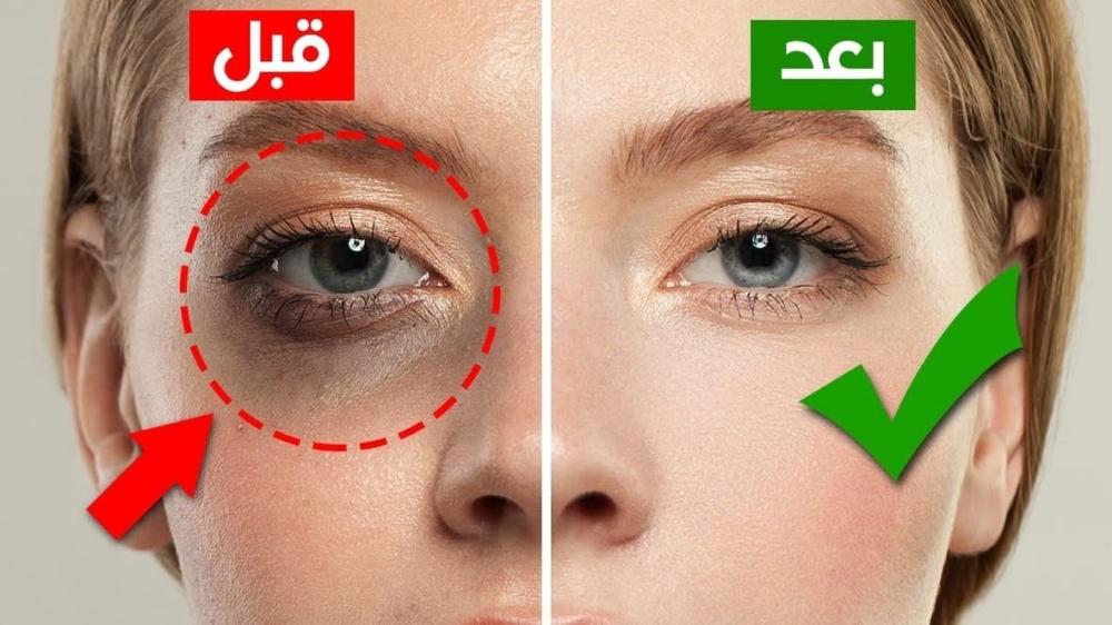 استراتيجيات فعّالة للتخلص من الهالات السوداء والانتفاخ تحت العينين