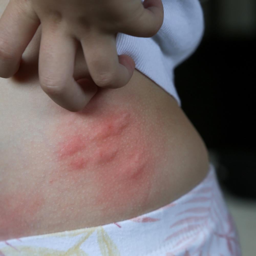 شكل قرصة بق الفراش: كيف تميزها بسهولة؟ دليل شامل للكبار والأطفال