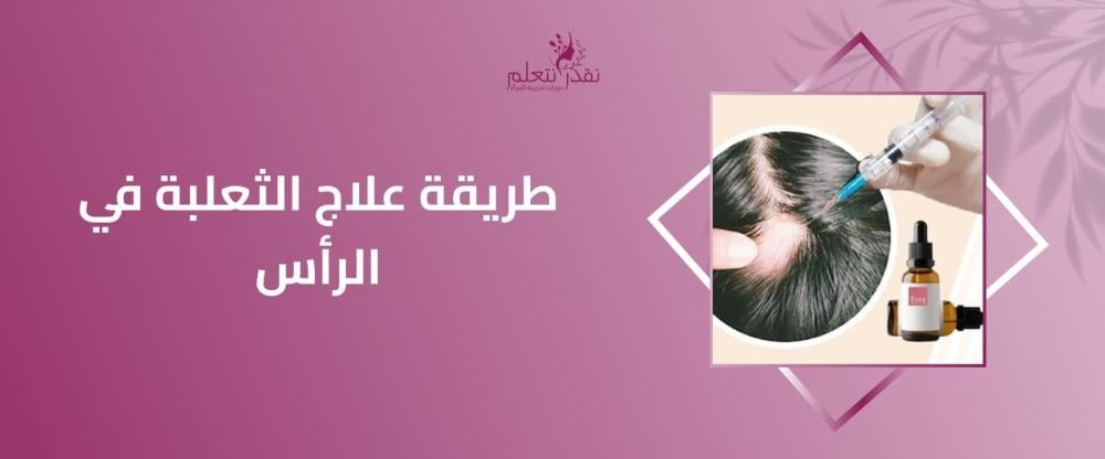 طريقة علاج الثعلبة في الرأس طريقة علاج الثعلبة في الرأس