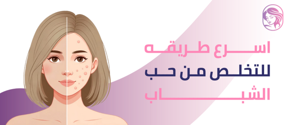 اسرع طريقه للتخلص من حب الشباب آمنة وفعالة