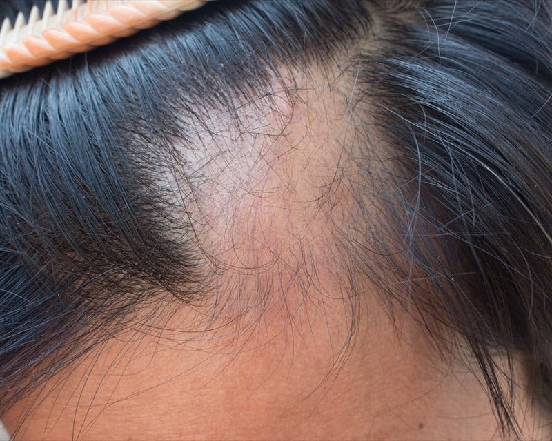 هل يمكن أن تؤثر ببتيدات الكولاجين على نمو الشعر؟