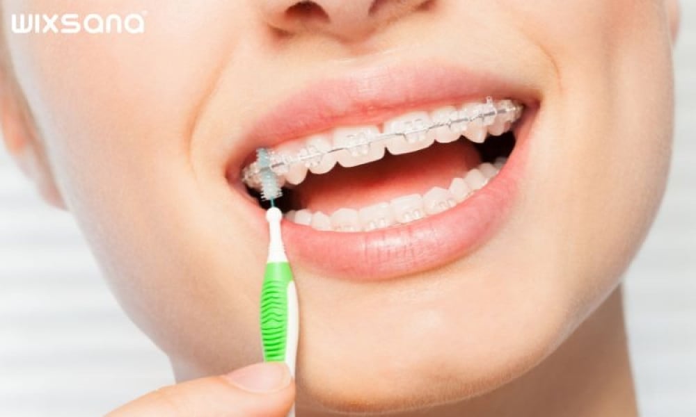 Tennrensing mens tannregulering er på plass