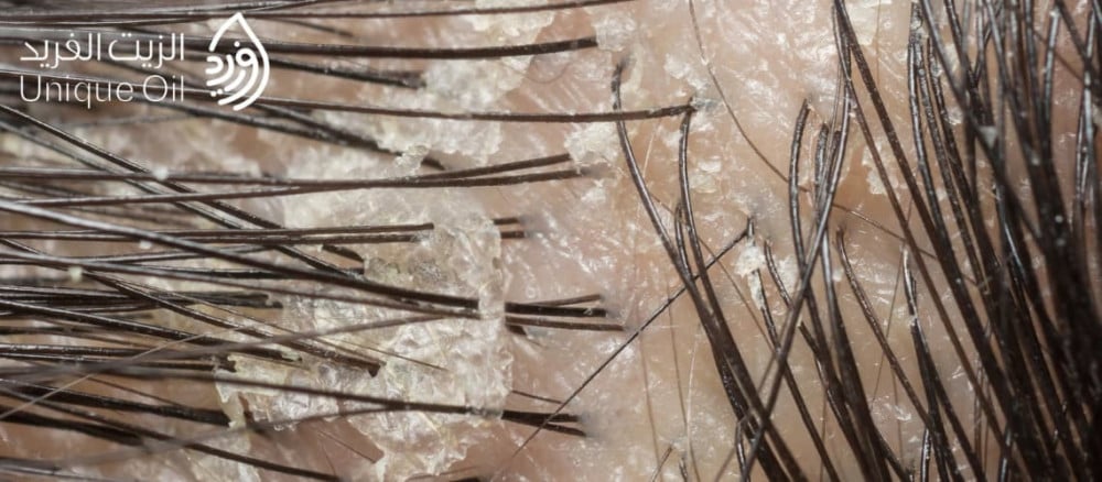 هل تعانين من فروة الرأس الدهنية ؟ افضل زيوت لعلاج فروة الشعر الدهني