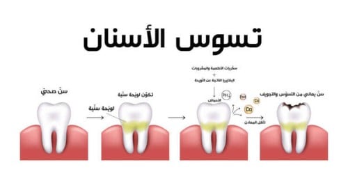 جلسة تسوس سن واحد مع أشعة