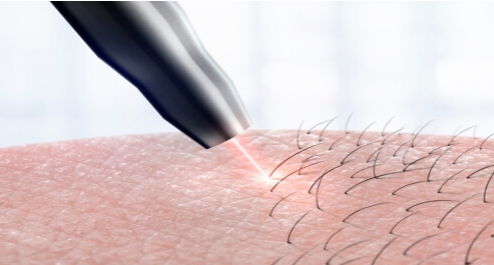 جلسة ليزر ازالة شعر بكيني