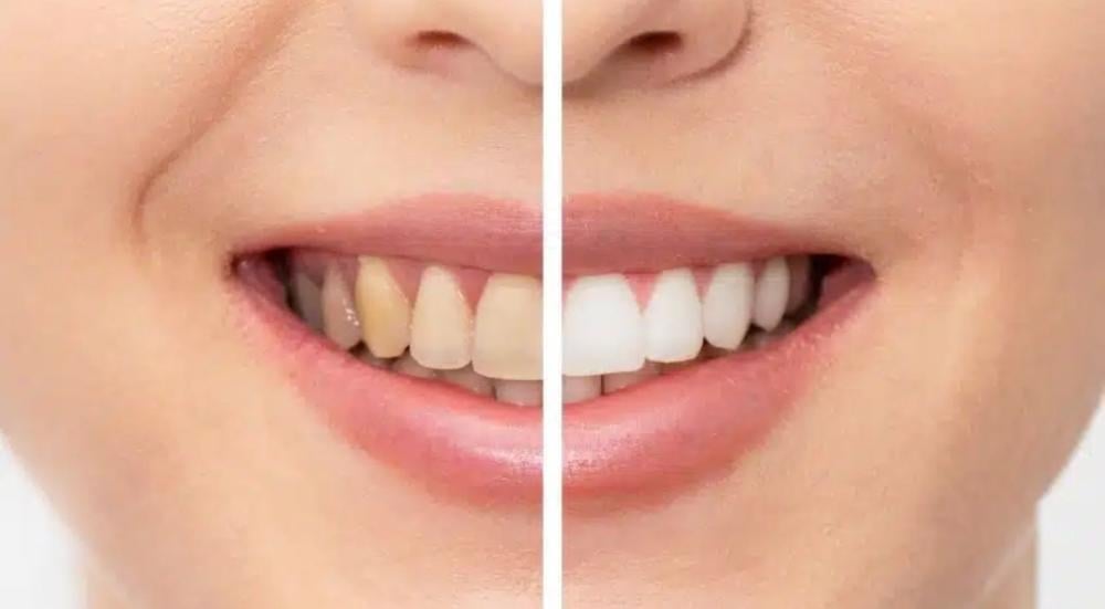 whitening-toothpaste