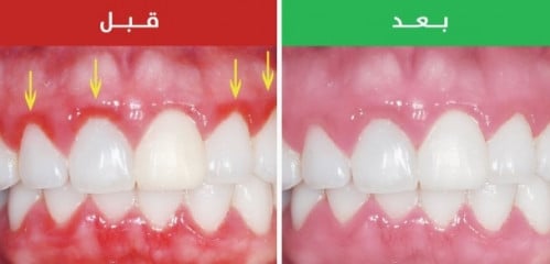 قطع اللثة جراحي للفك الواحد