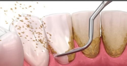تنظيف الاسنان البسيط