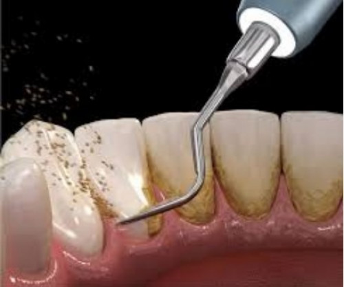 تنظيف الاسنان مع الترسبات (عميق)
