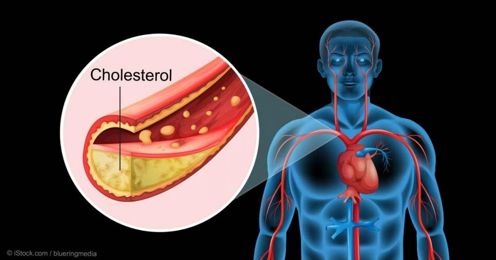 High cholesterol diagnosis and treatment