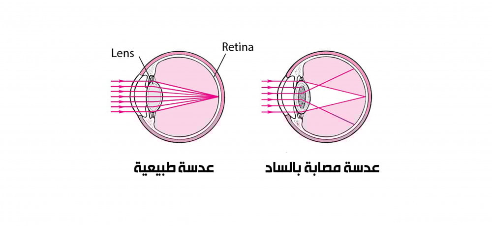 عدسة العين , نظارات طبية