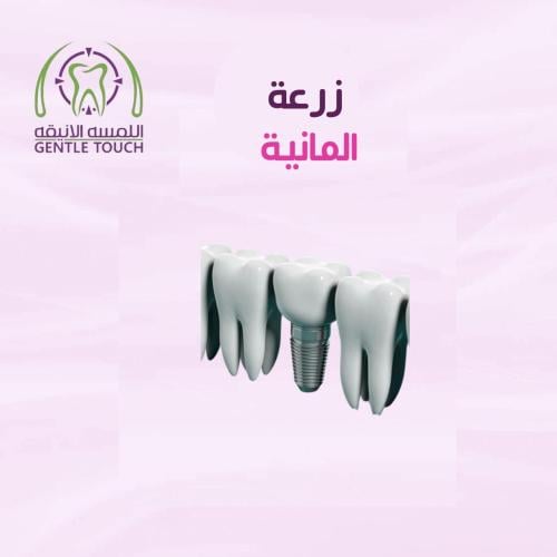 زرعة أسنان ألمانية