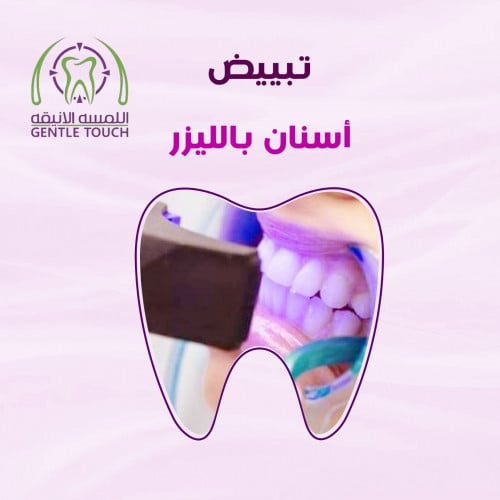 تبييض الاسنان بالليزر