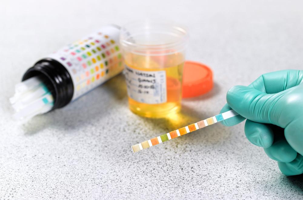 ما هو التحليل الذي يكشف عن تعاطي المخدرات؟