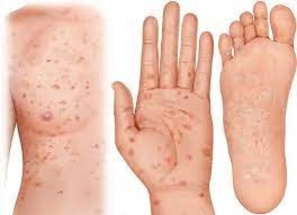 متى يكون اختبار الزهري دقيقا