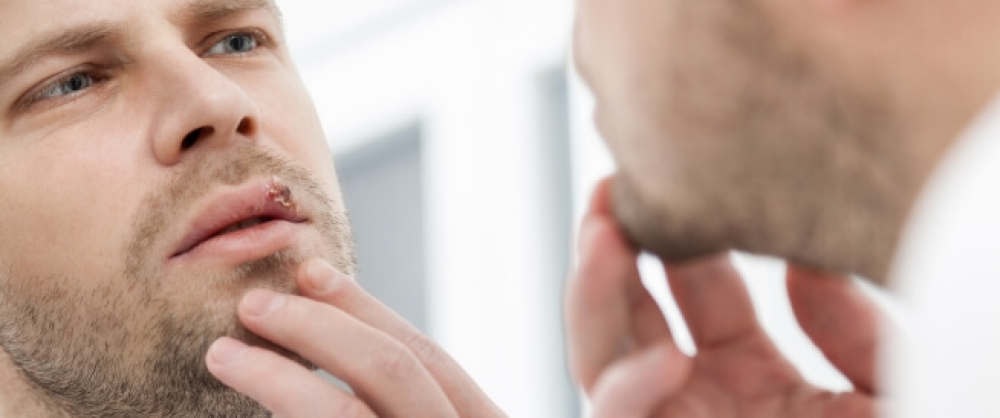 ما هو شكل هربس الفم