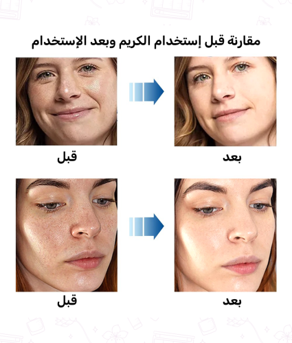 كريم حمض الهيالورونيك معالج لأنواع البشرة ومعالج ل...