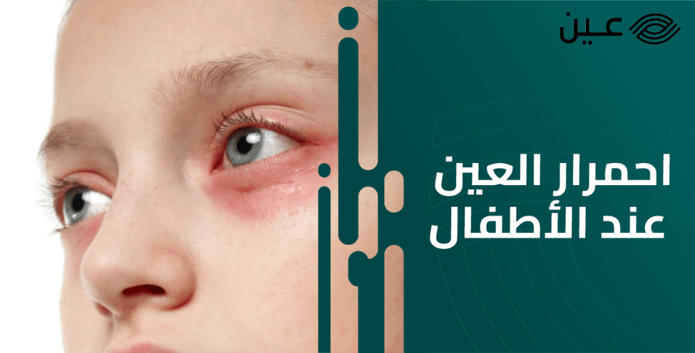 أسباب احمرار العين عند الأطفال