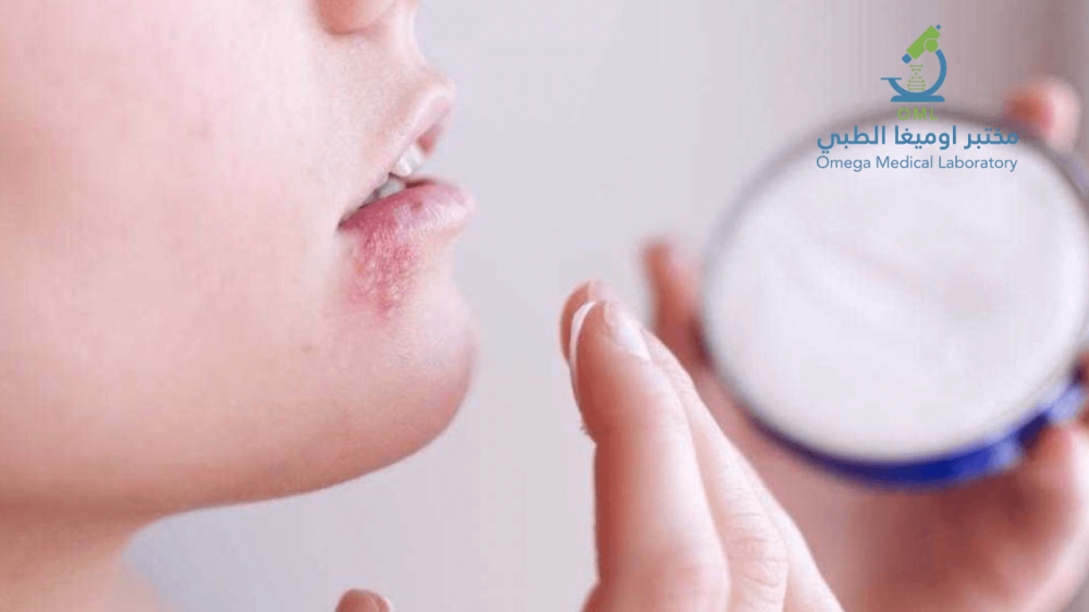 متى تظهر أعراض الهربس