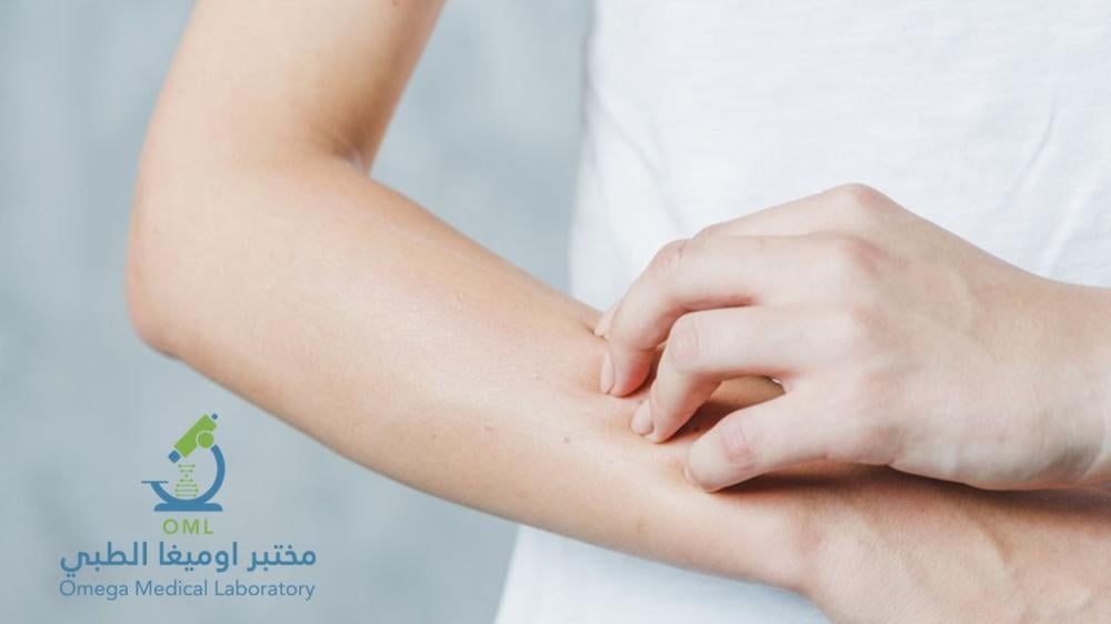 حساسية الجلد من الأكل