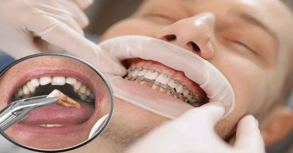 أضرار خلع الأسنان للتقويم ومتى يكون ضروريًا