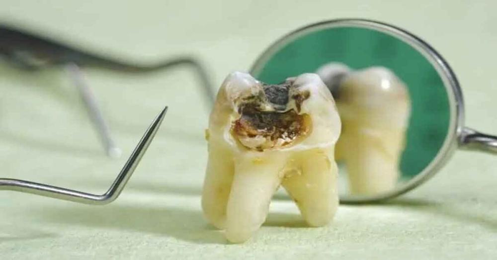 علاج ضرس العقل المسوس