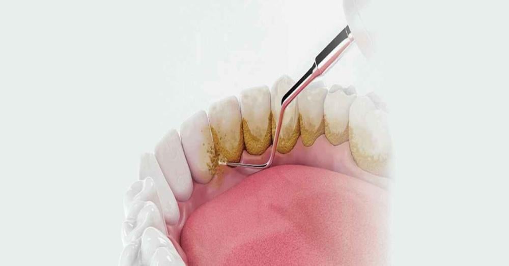 اسعار تنظيف جير الاسنان