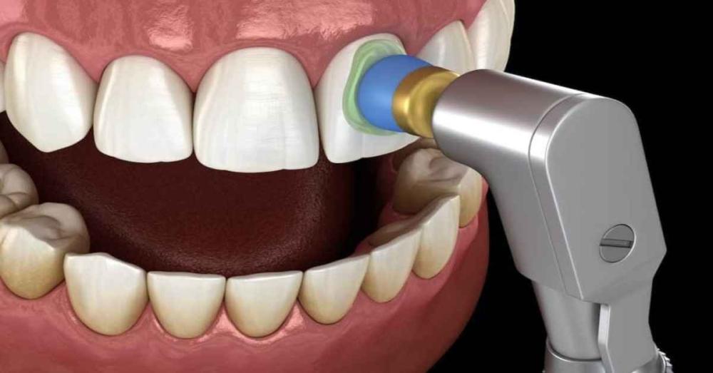 أسعار تلميع الأسنان