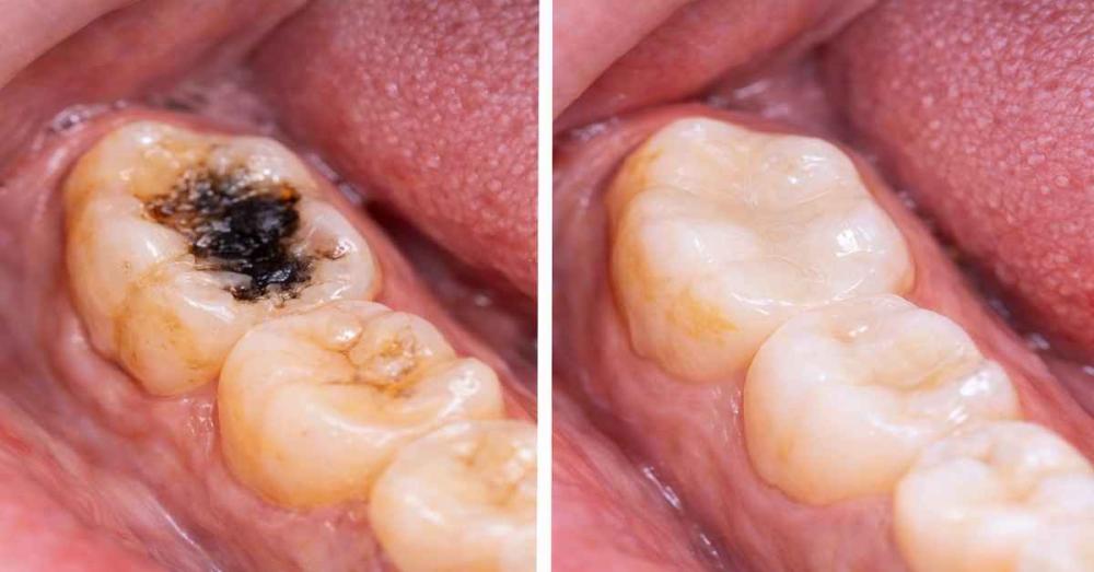 حشو اسنان قبل وبعد