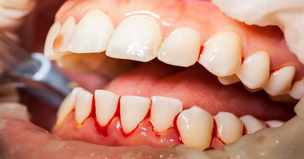 علاج نزيف اللثة ورائحة الفم الكريهة