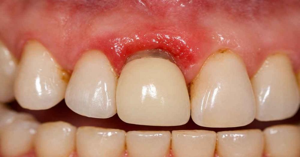 التهاب اللثة فوق التلبيسة