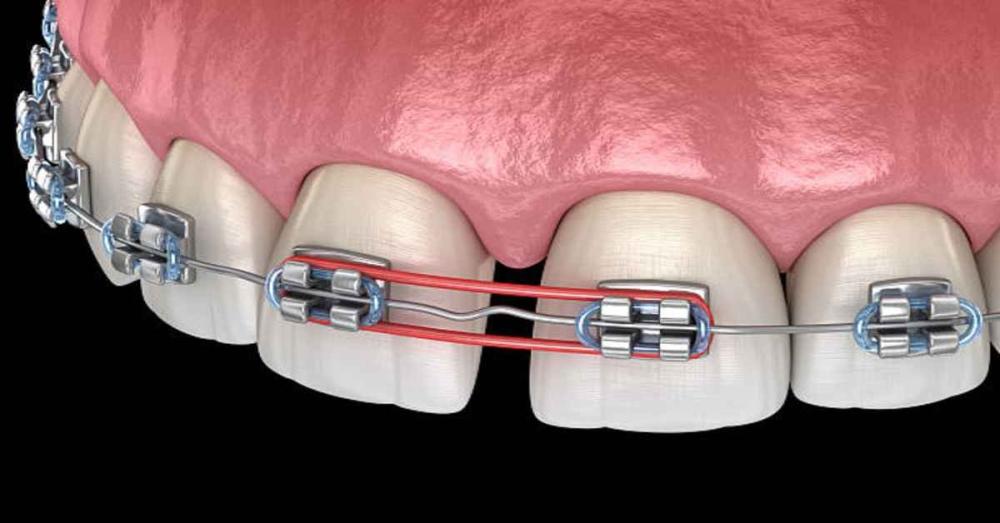 كم مدة تقويم الأسنان لسد الفراغات