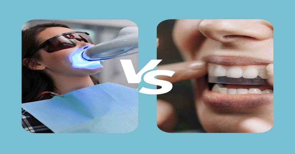 الفرق بين التبييض المنزلي والتبييض بالليزر