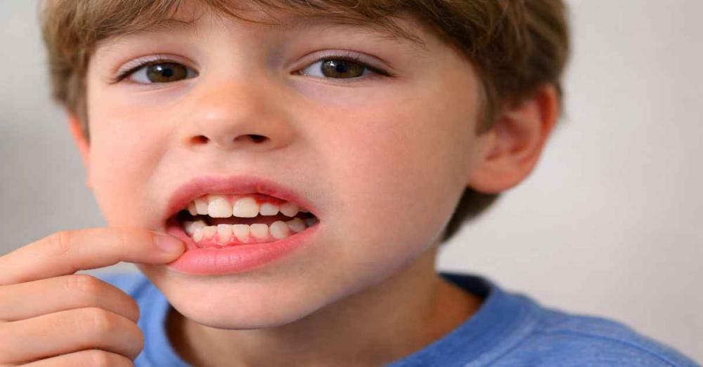 مشاكل اللثة عند الاطفال
