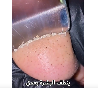 جهاز تنظيف البشرة وازالة الدهون