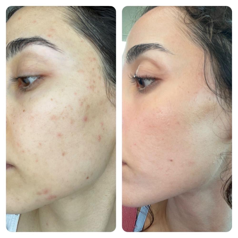 تفتيح البشرة وعلاج التصبغات