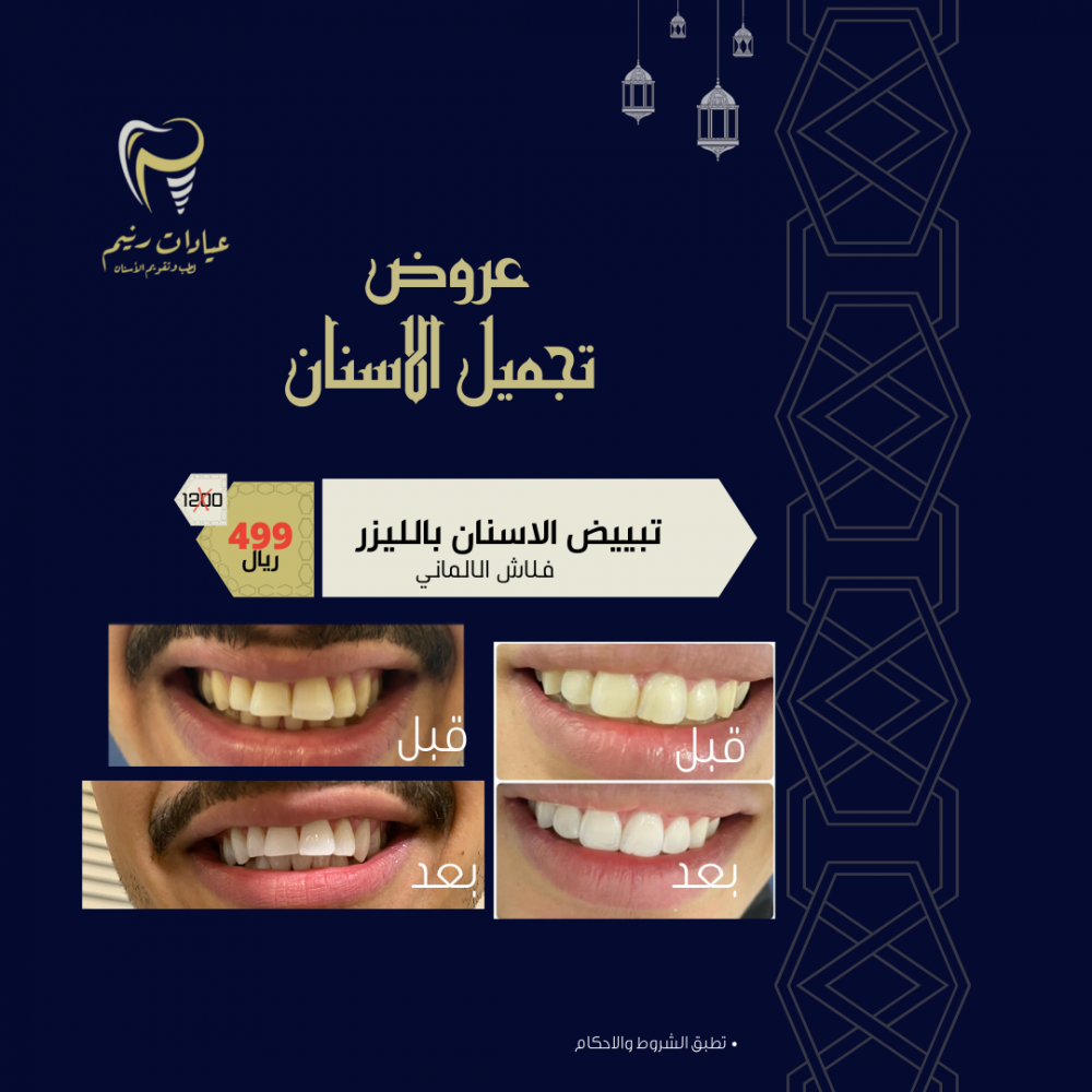 Anoi واعد مغامرة  عرض رمضان لتبييض الاسنان - عيادات رنيم