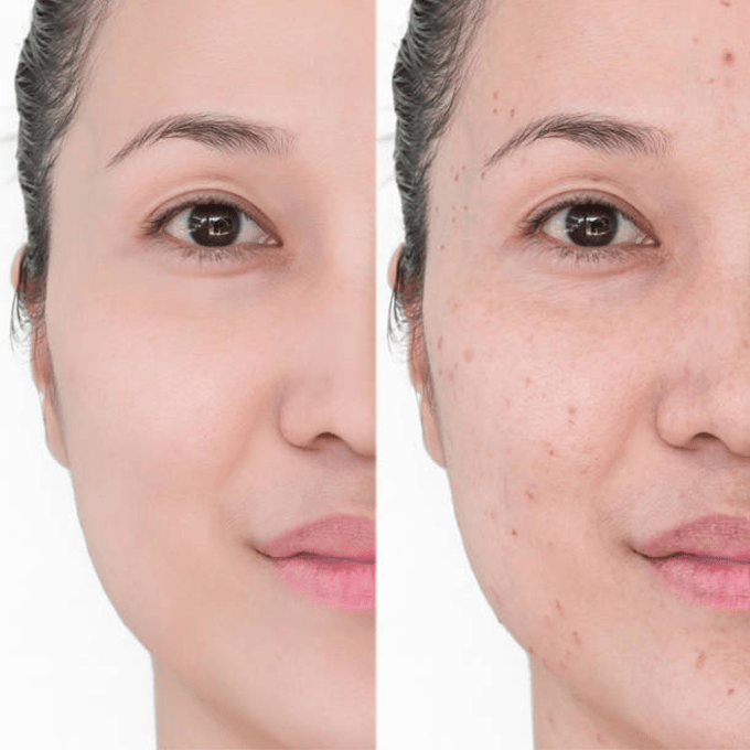 كريم اكرتين 0.25% لعلاج حب الشباب - 30جم