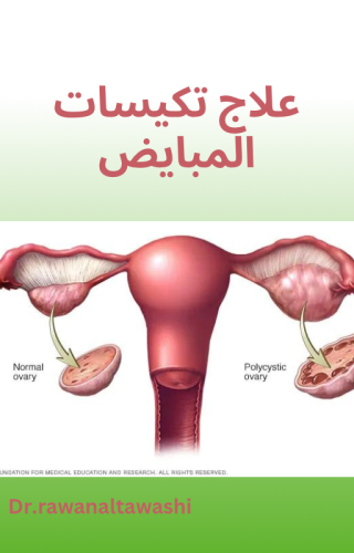 علاج تكيسات المبايض