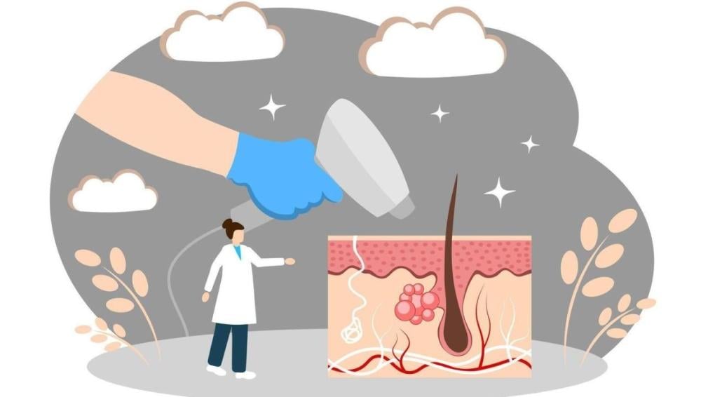 الليزر المنزلي للمنطقة الحساسة