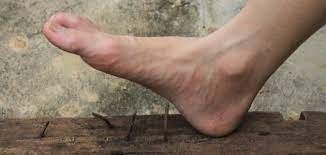 الكزاز أو التيتانوس (بالإنجليزية: Tetanus)‏