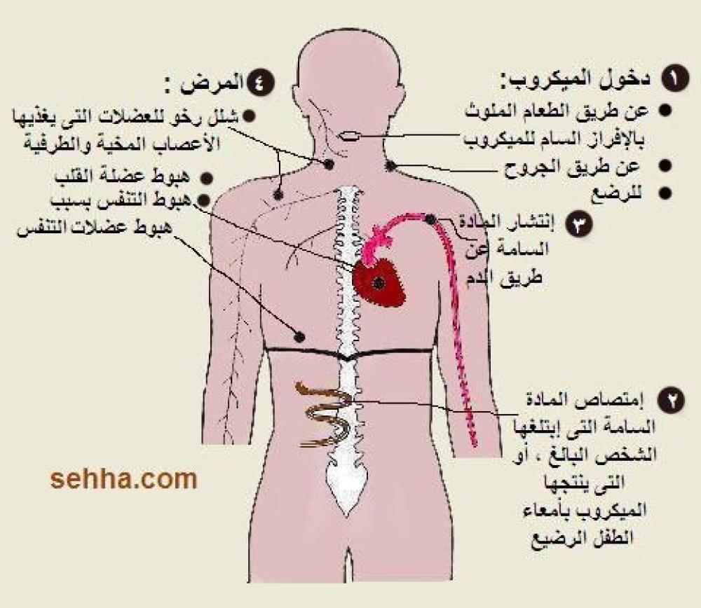التسمم الوشيجي او الوشيقي في احد مطاعم مدينة  الرياض