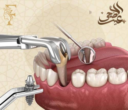 زراعة أسنان صناعية أمريكية ( شامل الأشعة + مراجعة مجانا)