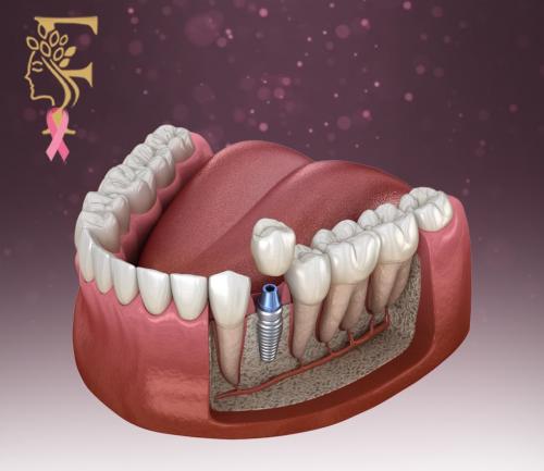 زراعة الفك الكامل ( شامل الأشعة + مراجعة مجانا )